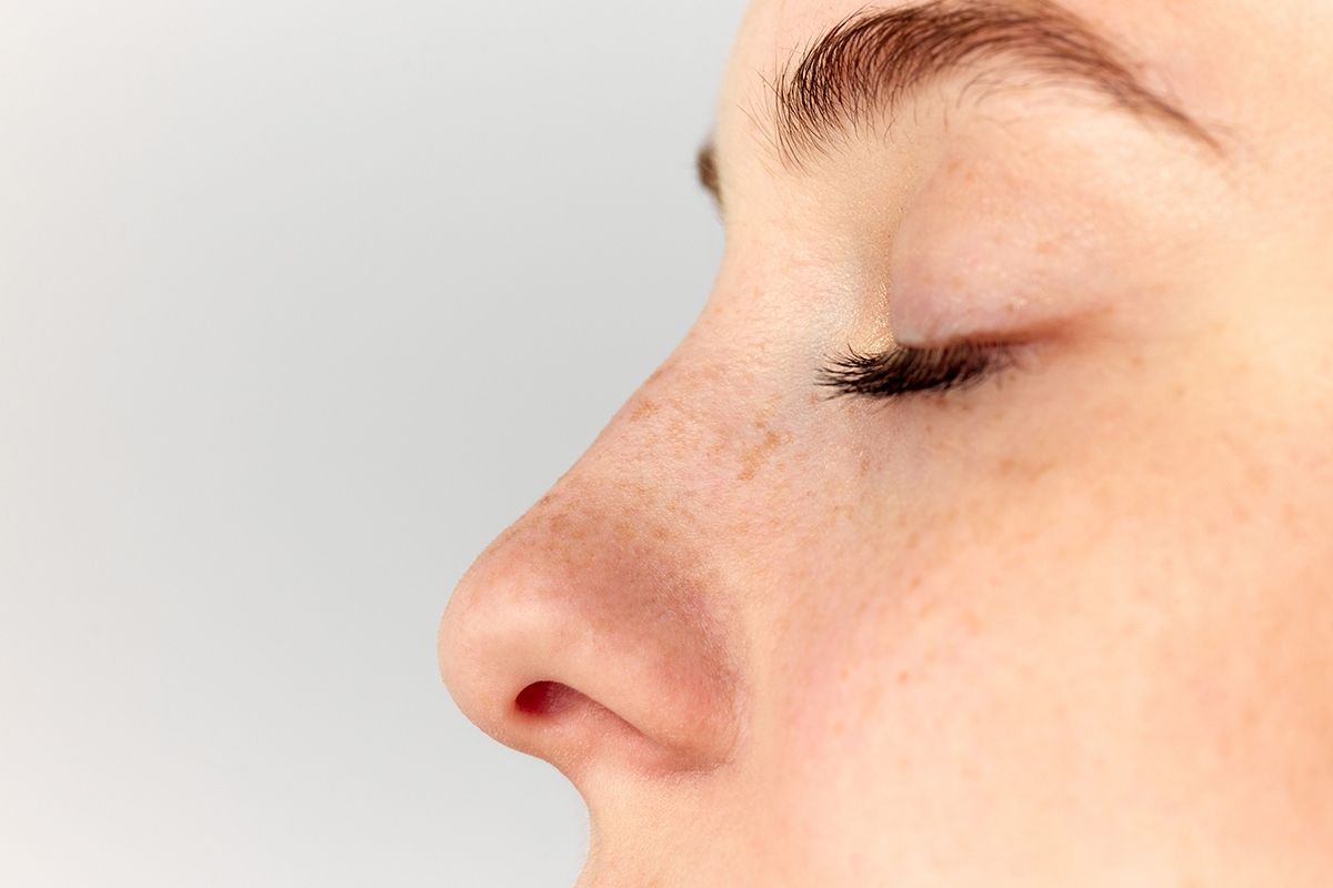 A woman's nose after functional rhinoplasty in NYC.