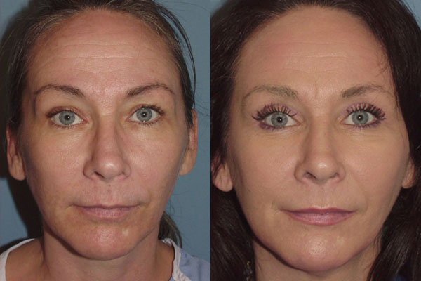before and after image showing a woman who's had upper eyelid surgery in NYC