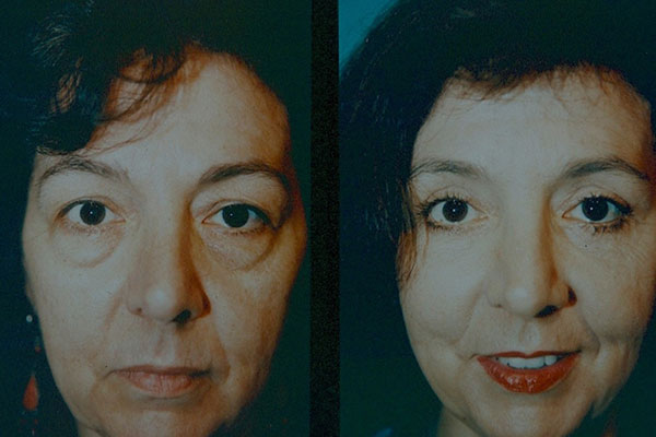 a woman who's had lower eyelid surgery in NYC