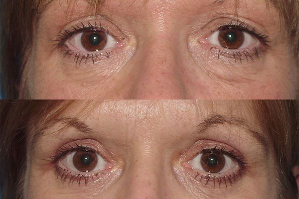 a before and after image of a woman who's had upper and lower eyelid surgery in NYC