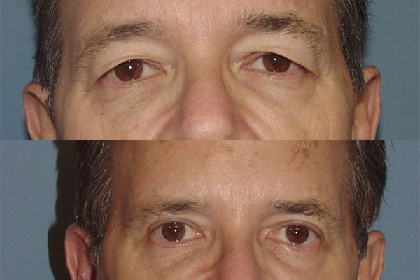 before and after image of a man who's had upper eyelid surgery in NYC
