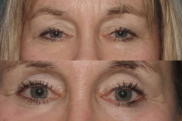 a before and after image of a woman who's had upper and lower eyelid surgery in NYC