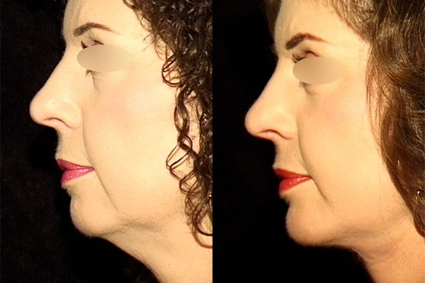 Nose job patient of best plastic surgeon NYC, Dr. Guida.