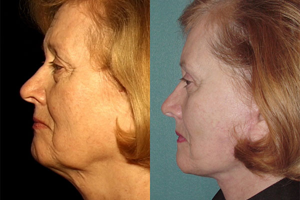 Rhinoplasty patient of best facelift surgeon NYC, Dr. Guida.