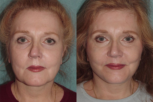 Facelift patient of best facelift surgeon NYC.