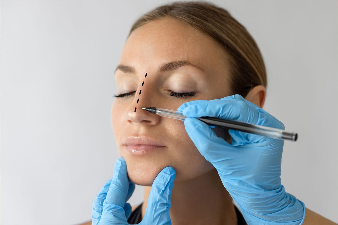 8 Reasons Patients May Consider Revision Rhinoplasty